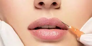 Dissolving Filler Treatment in Commerce Township, MI by Refine and Refresh Med Spa